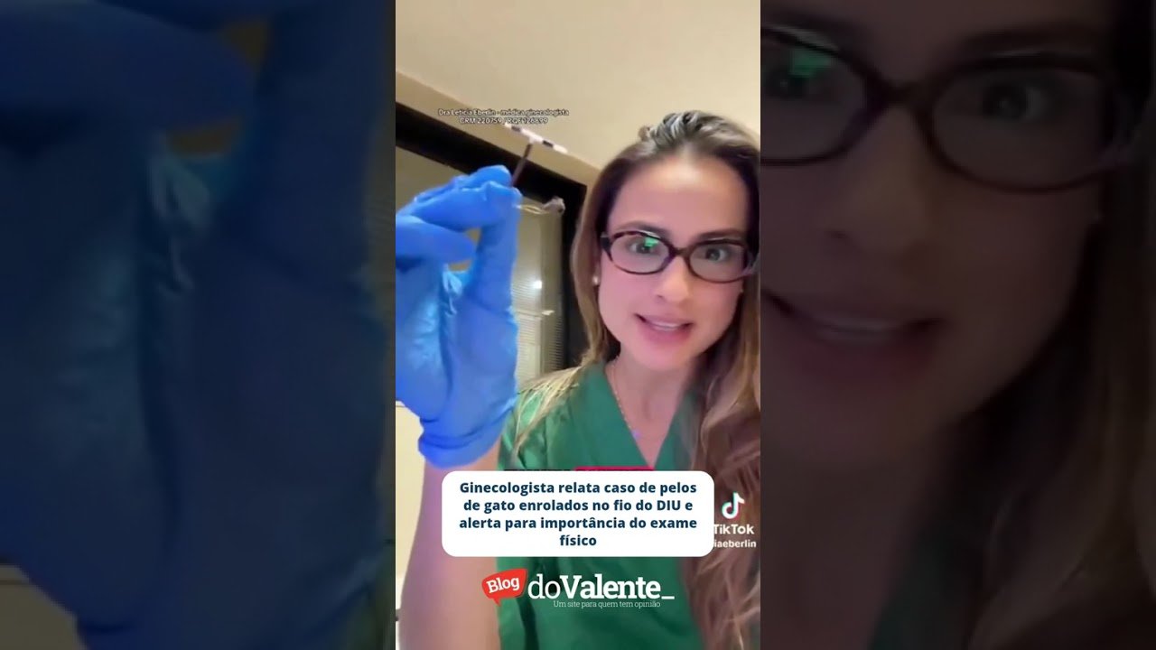 Ginecologista relata caso de pelos de gato enrolados no fio do DIU e alerta para importância do exame físico !