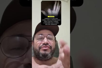 HOMEM PICADO POR COBRA CORTA O PRÓPRIO DEDO PARA CONTER O VENENO E DESCOBRE QUE ELA NÃO ERA VENENOSA !