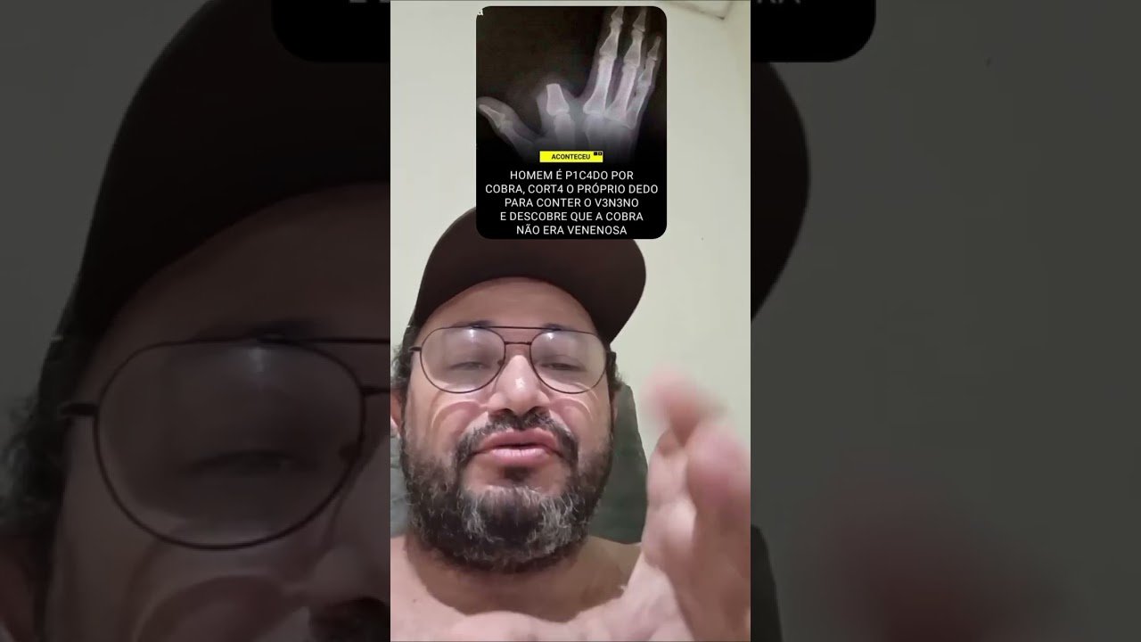 HOMEM PICADO POR COBRA CORTA O PRÓPRIO DEDO PARA CONTER O VENENO E DESCOBRE QUE ELA NÃO ERA VENENOSA !