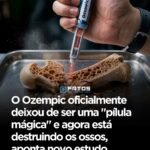 O Ozempic oficialmente deixou de ser uma “pílula mágica” e agora está destruindo os ossos, aponta novo estudo