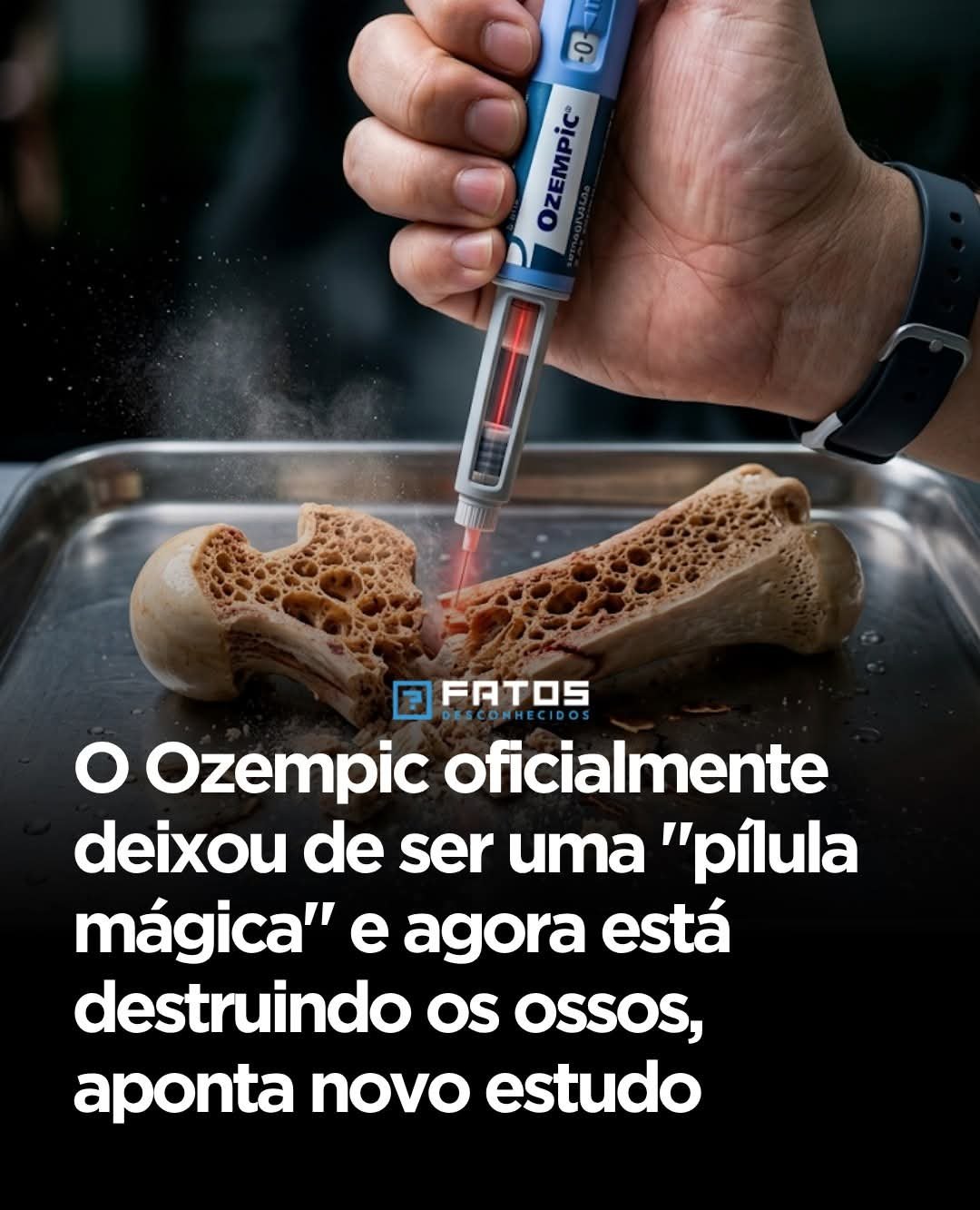 O Ozempic oficialmente deixou de ser uma “pílula mágica” e agora está destruindo os ossos, aponta novo estudo