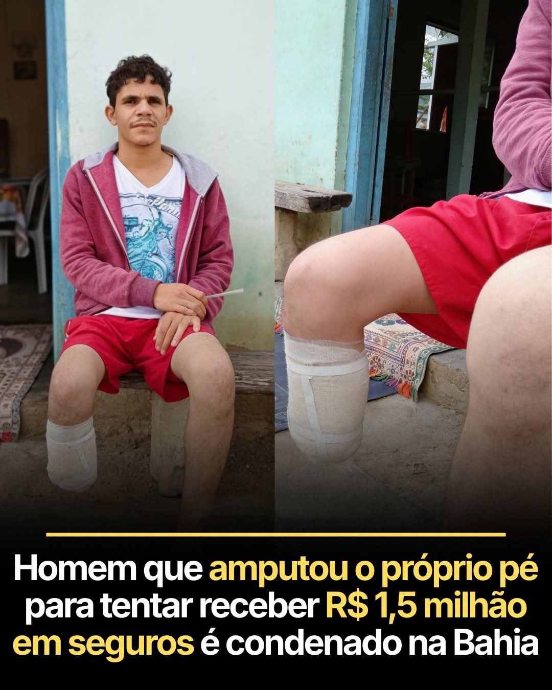 Homem que amputou o próprio pé para tentar receber R$ 1,5 milhão em seguros é condenado na Bahia
