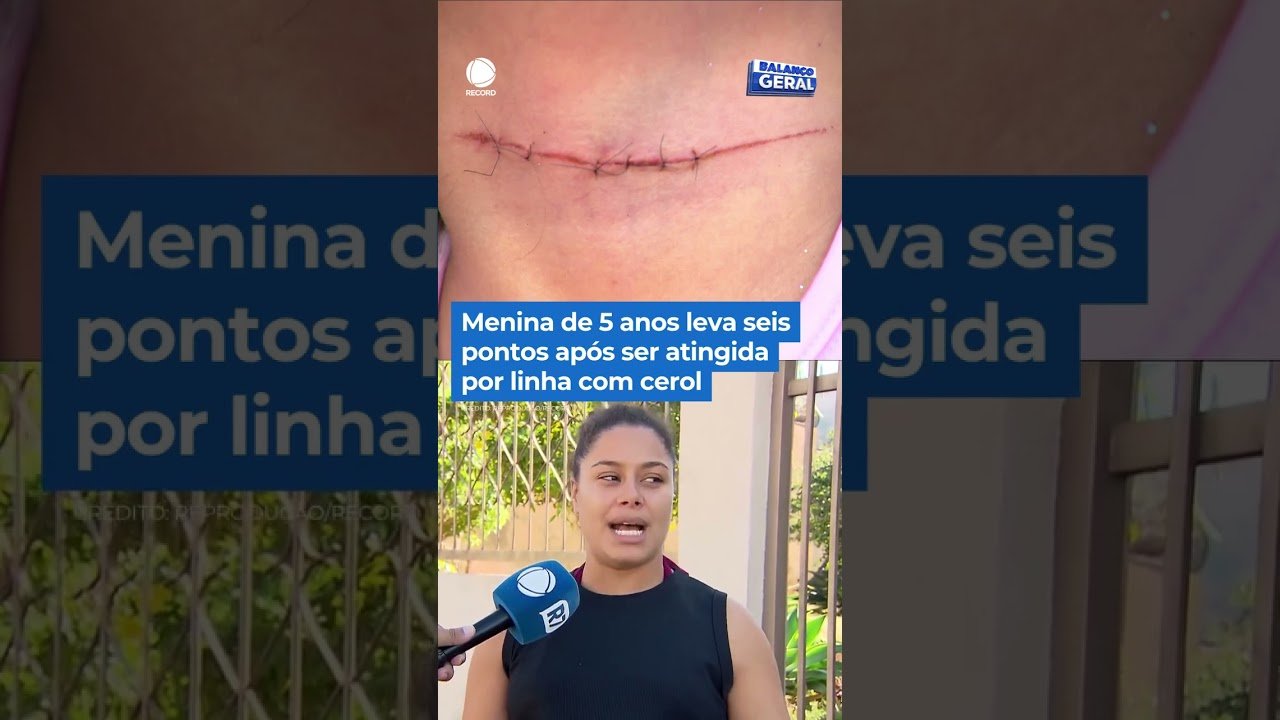 Menina de 5 anos leva sei pontos após ser atingida por linha com cerol em São Paulo!