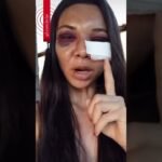 Mulher espancada pelo companheiro no Pl diz que foi a 1º agressão: ‘isso não é para se perdoar Mulher espancada pelo companheiro no Pl diz que foi a 1º agressão: ‘isso não é para se perdoar