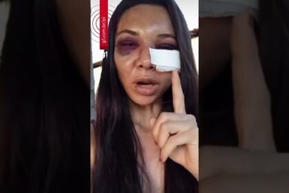 Mulher espancada pelo companheiro no Pl diz que foi a 1º agressão: ‘isso não é para se perdoar