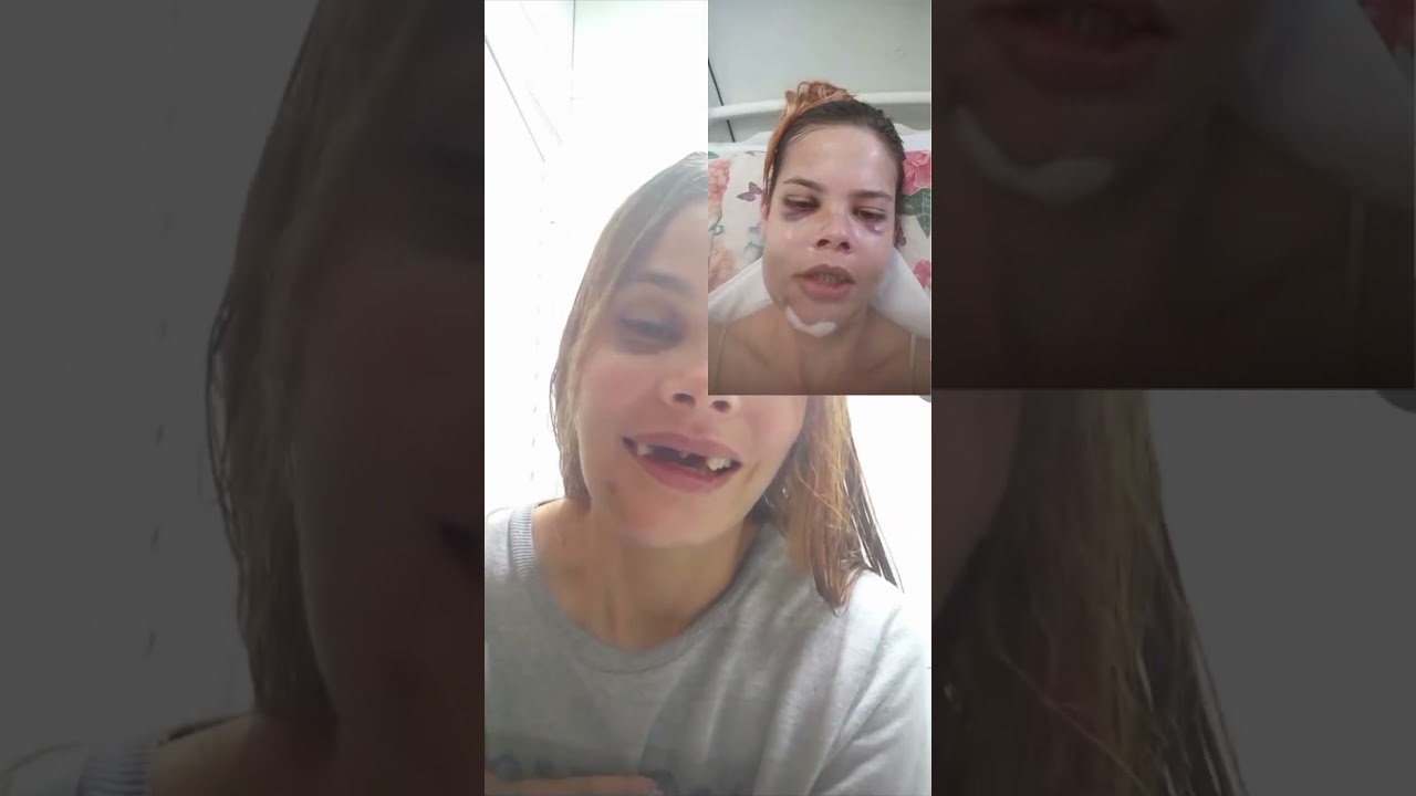 Jovem faz relato após sofrer gravíssimo acidente de moto! 💔🥺
