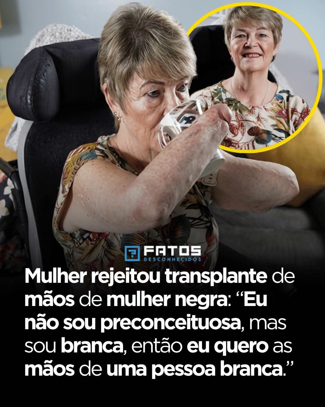 Mulher rejeitou transplante de mãos de mulher negra: “Eu não sou preconceituosa, mas sou branca, então eu quero as mãos de uma pessoa branca.