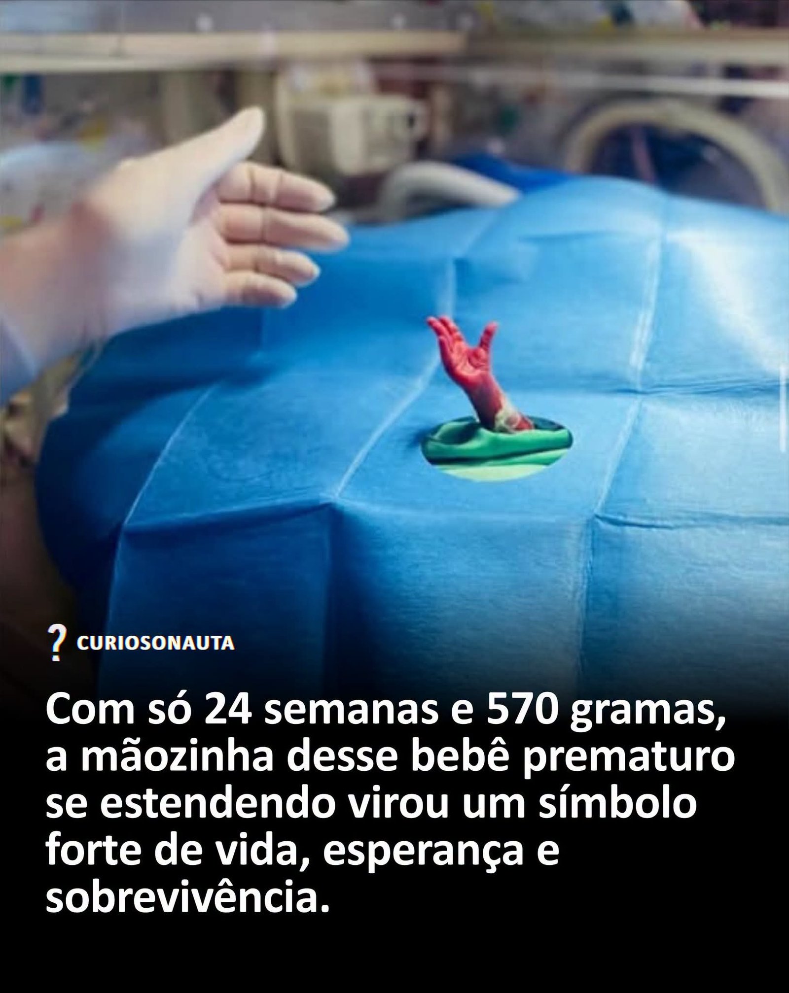 Com só 24 semanas e 570 gramas, a mãozinha desse bebê prematuro se estendendo virou um símbolo forte de vida, esperança e sobrevivência Com só 24 semanas e 570 gramas, a mãozinha desse bebê prematuro se estendendo virou um símbolo forte de vida, esperança e sobrevivência