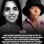 APÓS SOFRER QUEIMADURAS EM MAIS DE 60% DO CORPO E TER O ROSTO DESFIGURADO EM UM ACIDENTE PROVOCADO POR UM MOTORISTA EMBRIAGADO, JACQUELINE SABURIDO TRANSFORMOU SUA TRAGÉDIA EM UMA LUTA CONTRA O ÁLCOOL AO VOLANTE E SE TORNOU UM SÍMBOLO MUNDIAL DA CONSCIENTIZAÇÃO NO TRÂNSITO. APÓS SOFRER QUEIMADURAS EM MAIS DE 60% DO CORPO E TER O ROSTO DESFIGURADO EM UM ACIDENTE PROVOCADO POR UM MOTORISTA EMBRIAGADO, JACQUELINE SABURIDO TRANSFORMOU SUA TRAGÉDIA EM UMA LUTA CONTRA O ÁLCOOL AO VOLANTE E SE TORNOU UM SÍMBOLO MUNDIAL DA CONSCIENTIZAÇÃO NO TRÂNSITO.