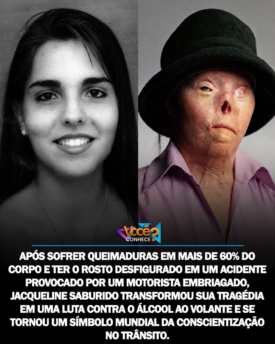 APÓS SOFRER QUEIMADURAS EM MAIS DE 60% DO CORPO E TER O ROSTO DESFIGURADO EM UM ACIDENTE PROVOCADO POR UM MOTORISTA EMBRIAGADO, JACQUELINE SABURIDO TRANSFORMOU SUA TRAGÉDIA EM UMA LUTA CONTRA O ÁLCOOL AO VOLANTE E SE TORNOU UM SÍMBOLO MUNDIAL DA CONSCIENTIZAÇÃO NO TRÂNSITO. APÓS SOFRER QUEIMADURAS EM MAIS DE 60% DO CORPO E TER O ROSTO DESFIGURADO EM UM ACIDENTE PROVOCADO POR UM MOTORISTA EMBRIAGADO, JACQUELINE SABURIDO TRANSFORMOU SUA TRAGÉDIA EM UMA LUTA CONTRA O ÁLCOOL AO VOLANTE E SE TORNOU UM SÍMBOLO MUNDIAL DA CONSCIENTIZAÇÃO NO TRÂNSITO.