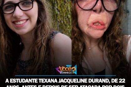 ESTUDANTE TEXANA JACQUELINE DURAND, DE 22 ANOS, ANTES E DEPOIS DE SER ATACADA POR DOIS CÃES DOS QUAIS CUIDAVA. OS ANIMAIS ARRANCARAM E COMERAM SUAS ORELHAS, NARIZ, LÁBIOS E GRANDE PARTE DO ROSTO ABAIXO DOS OLHOS. ELA SOFREU MAIS DE 800 MORDIDAS E FICOU PERMANENTEMENTE DESFIGURADA.