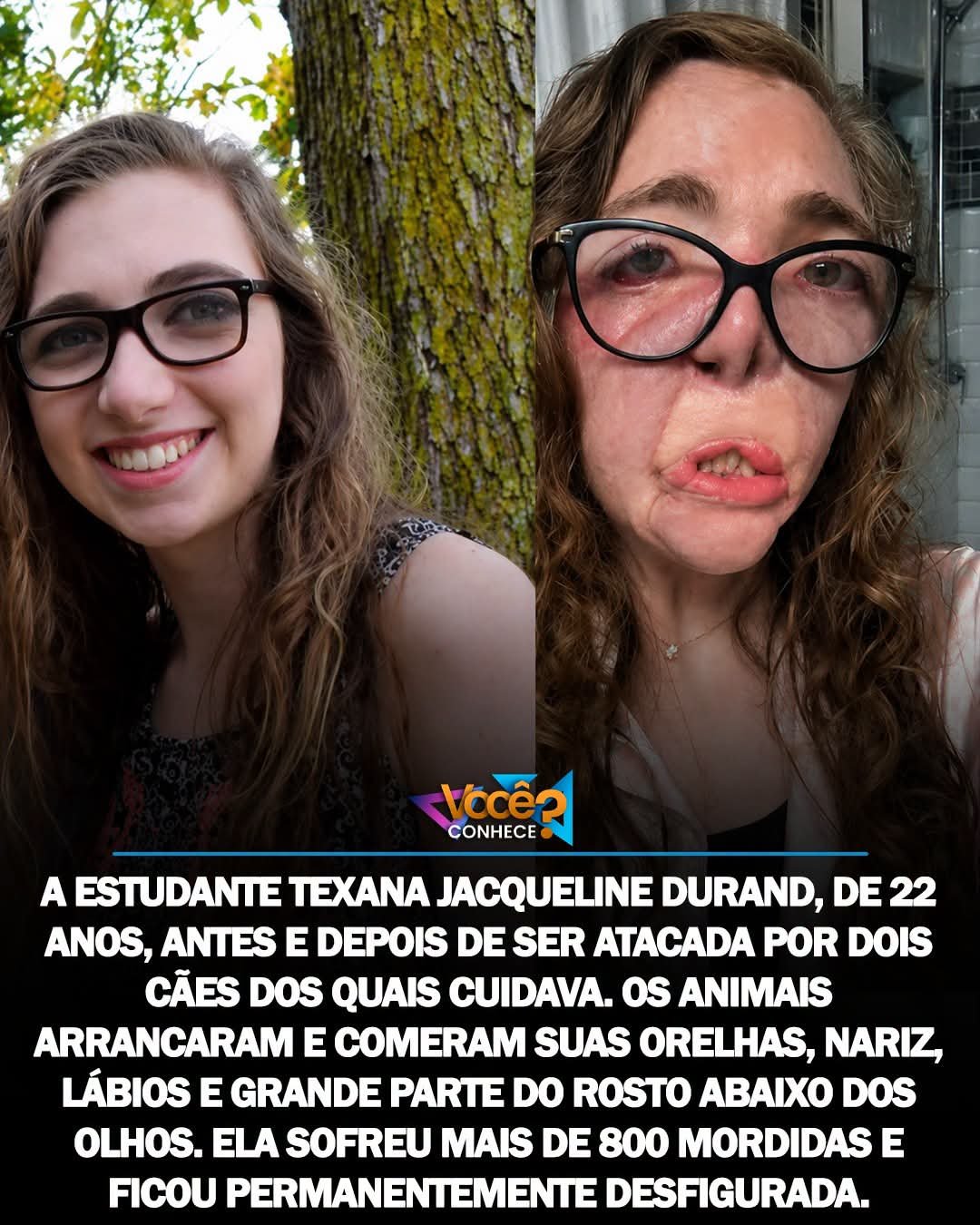 ESTUDANTE TEXANA JACQUELINE DURAND, DE 22 ANOS, ANTES E DEPOIS DE SER ATACADA POR DOIS CÃES DOS QUAIS CUIDAVA. OS ANIMAIS ARRANCARAM E COMERAM SUAS ORELHAS, NARIZ, LÁBIOS E GRANDE PARTE DO ROSTO ABAIXO DOS OLHOS. ELA SOFREU MAIS DE 800 MORDIDAS E FICOU PERMANENTEMENTE DESFIGURADA. ESTUDANTE TEXANA JACQUELINE DURAND, DE 22 ANOS, ANTES E DEPOIS DE SER ATACADA POR DOIS CÃES DOS QUAIS CUIDAVA. OS ANIMAIS ARRANCARAM E COMERAM SUAS ORELHAS, NARIZ, LÁBIOS E GRANDE PARTE DO ROSTO ABAIXO DOS OLHOS. ELA SOFREU MAIS DE 800 MORDIDAS E FICOU PERMANENTEMENTE DESFIGURADA.
