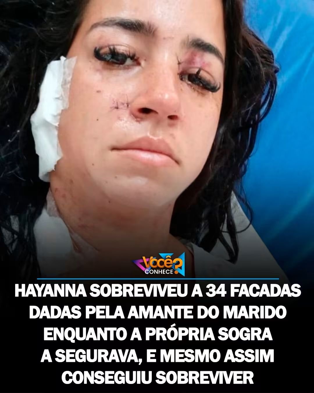 HAYANNA SOBREVIVEU A 34 FACADAS DADAS PELA AMANTE DO MARIDO.